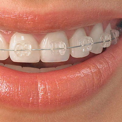 Clear braces