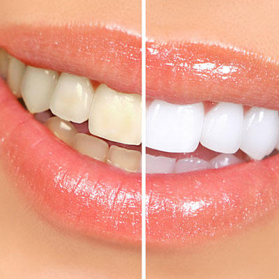 Teeth whitening before and after