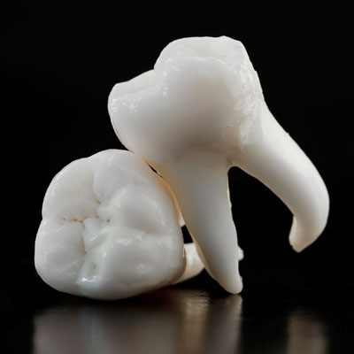 Wisdom teeth extrations